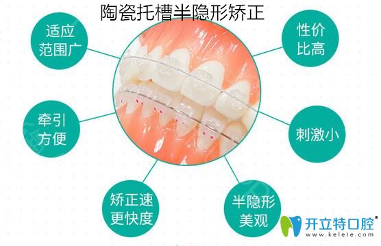 陶瓷托槽半隐形矫正图 陶瓷托槽半隐形矫正图