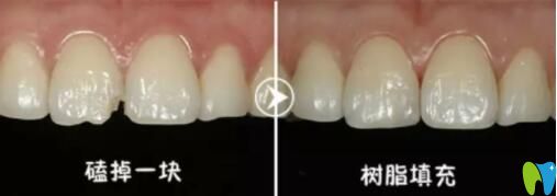 树脂填充补牙 树脂填充补牙