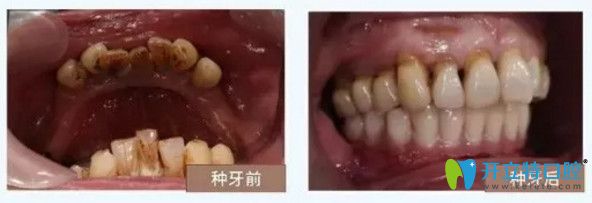 南宁柏乐口腔种植牙对比图