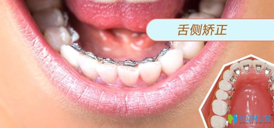 杨春犁医生讲解为什么很少人做舌侧矫正