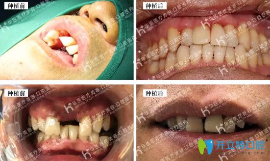 华医口腔数字化种植牙案例展示