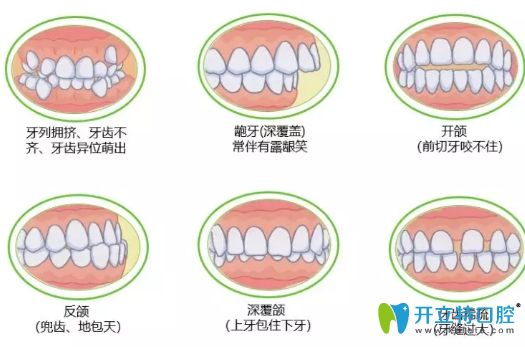 常见牙齿不齐的几种症状