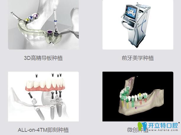 重庆美奥口腔4大种植技术