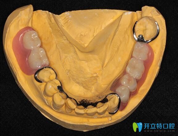 广州柏德口腔闫振介绍可摘局部义齿优势
