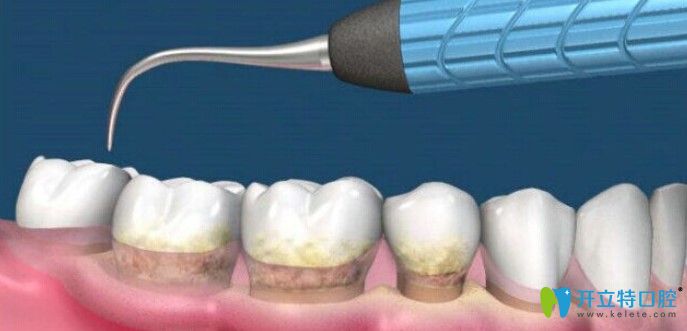 李懿来告诉大家为什么医生不建议做龈下刮治？