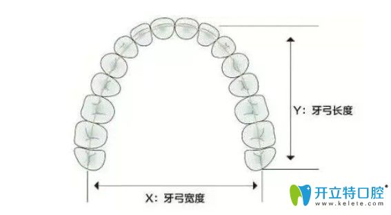 李可君医生给科普牙齿矫正的扩弓器有什么作用