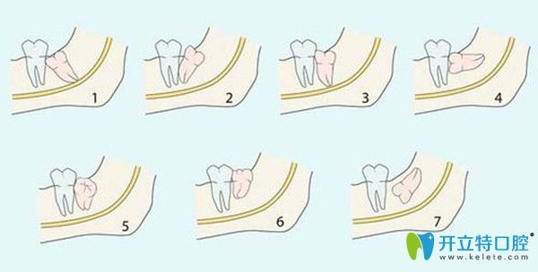 阻生智齿的七种情况