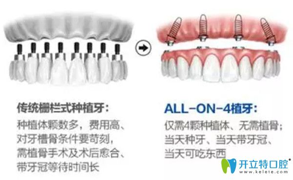 传统种牙和一日得种牙的区别