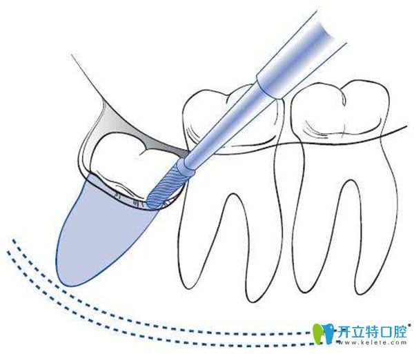 微创拔牙过程