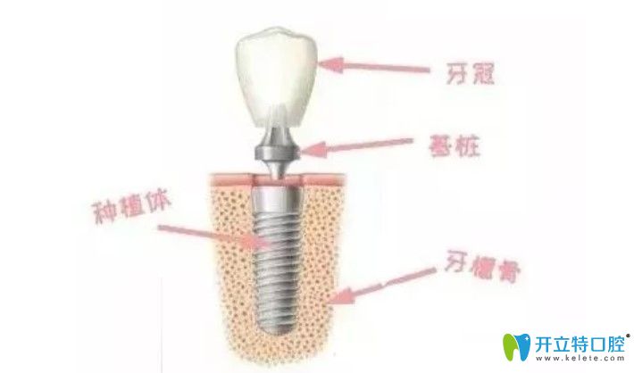 耿远明医生告诉你种植牙结构 耿远明医生告诉你种植牙结构