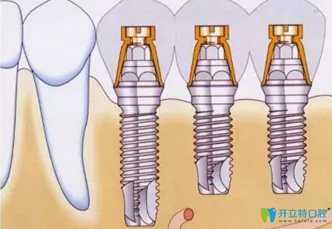 耿远明医生告诉你种植牙步骤 耿远明医生告诉你种植牙步骤