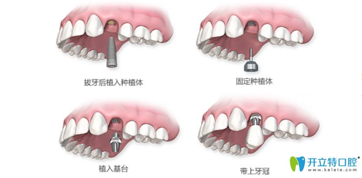 东莞好佰年口腔即刻种植牙图解