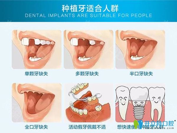 种植牙适宜人群