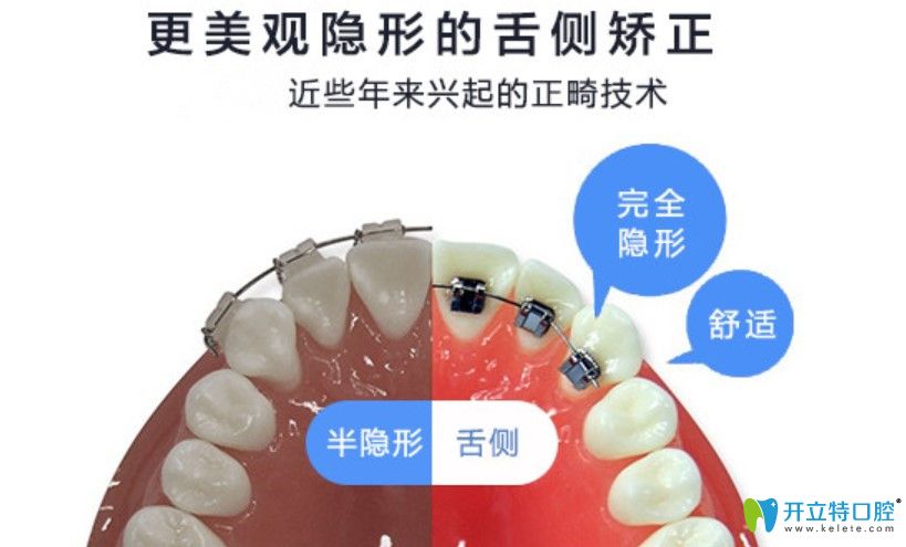 舌侧隐形矫正缺点 舌侧隐形矫正缺点