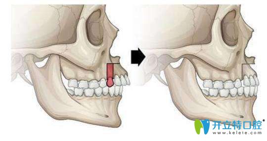骨性龅牙矫正