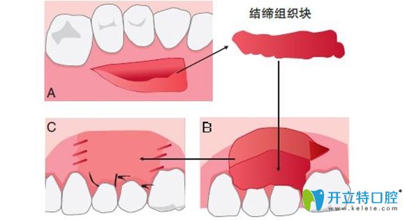 牙齿修补手术过程图解