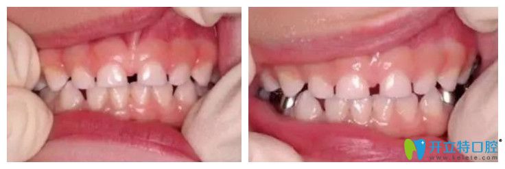儿童在带hall牙冠之前和带牙冠10天之后对比图