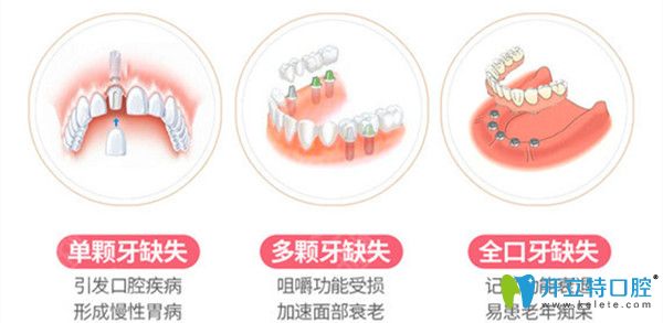 牙齿缺失会造成哪些影响