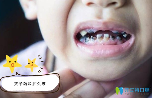 儿童龋齿磨牙治疗新技术hall冠