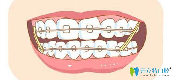 牙齿矫正可以恢复咬合关系
