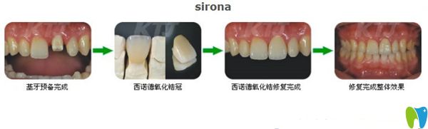 西诺德全瓷牙的制作过程