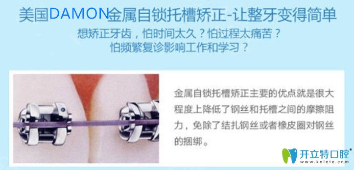 美国damon自锁托槽矫正优势 美国damon自锁托槽矫正优势