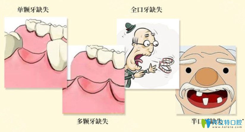 韩国sg与瑞士百丹特种植牙价格 韩国sg与瑞士百丹特种植牙价格