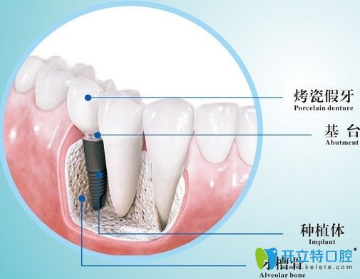 石家庄种植牙收费价格表 石家庄种植牙收费价格表