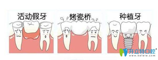 游离牙缺失选择种植牙还是烤瓷牙