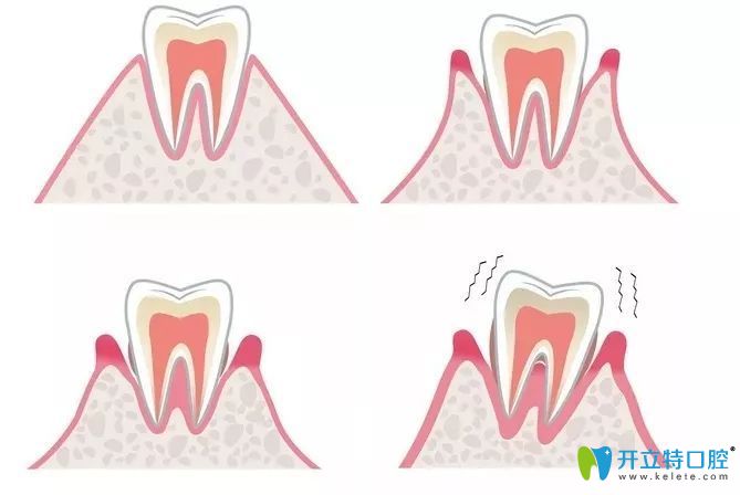 老掉牙是牙龈萎缩的表现