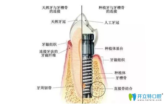 韩国SG种植牙好不好 韩国SG种植牙好不好