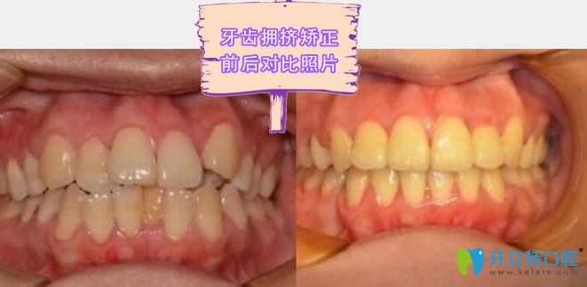 东营铂尔口腔牙齿拥挤矫正效果