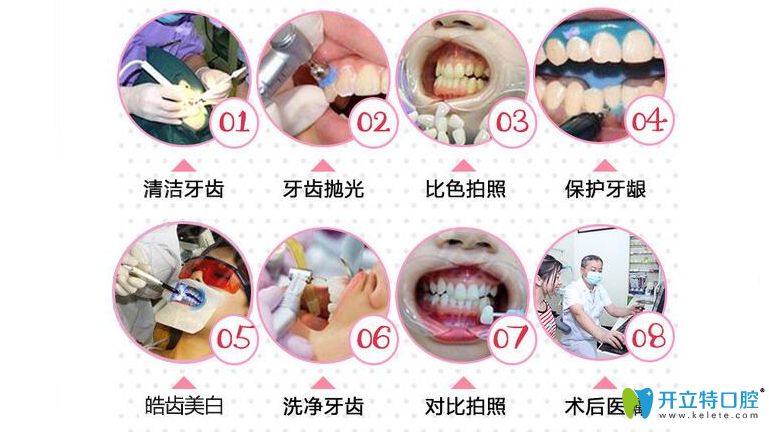 <!--<i data=20240703-sp></i>-->亿大口腔皓齿美白操作流程