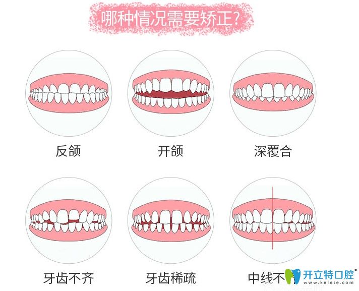 咱们来了解下哪些情况需要矫正