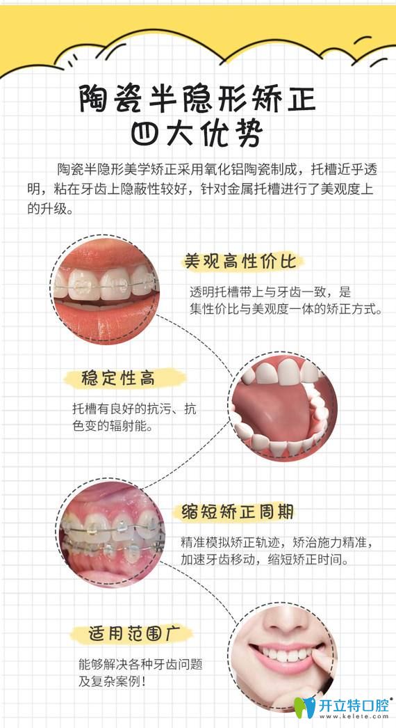 陶瓷半隐形矫正优势图 陶瓷半隐形矫正优势图