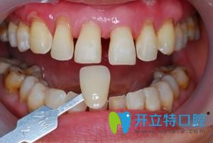 上海牙齿贴片多少钱?精心整理牙贴面价格含树脂瓷贴面区别