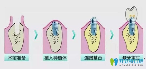 即刻种植牙 即刻种植牙