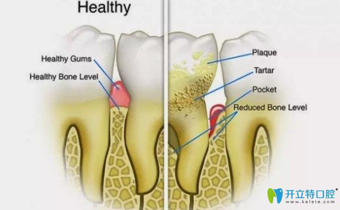 牙周治疗后需要注意哪些方面