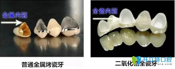 全瓷冠与烤瓷冠区别