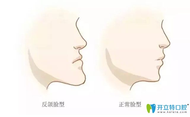 畸形牙齿影响面部软组织发育 畸形牙齿影响面部软组织发育