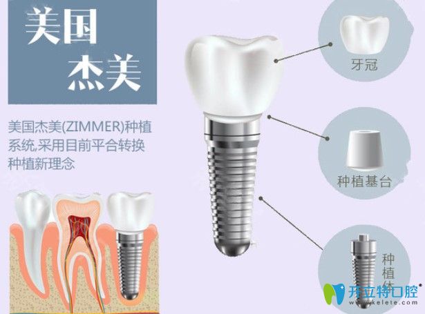 美国zimmer种植体特点