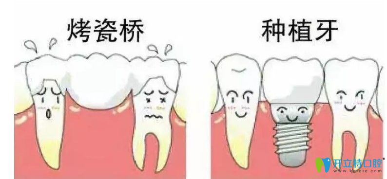 李胜刚解析牙齿缺失选择种植牙好还是烤瓷牙好