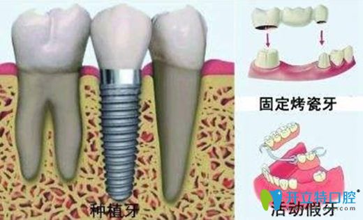 牙齿缺失的修复方法