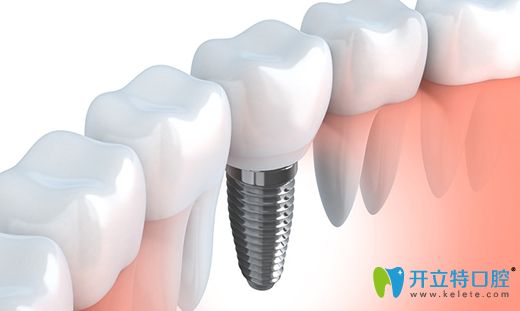 牙齿缺失的较好修复方式为种植牙