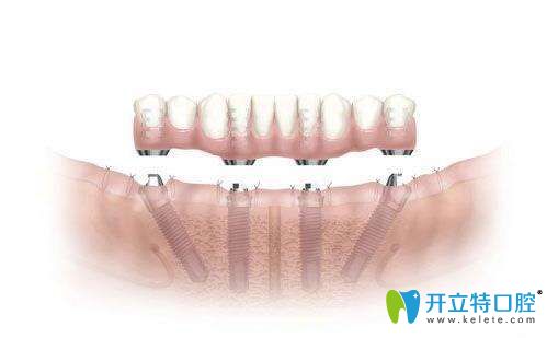 半口种植牙介绍图