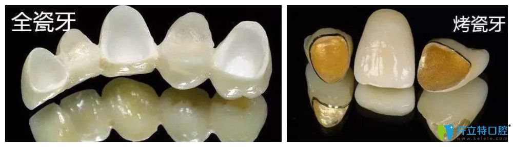 全瓷牙和烤瓷牙有啥区别 全瓷牙和烤瓷牙有啥区别