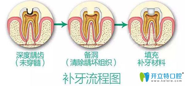 补牙流程