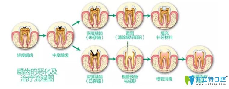 为什么有的人根管治疗后牙齿反而更疼