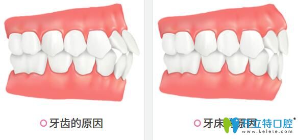 牙性龅牙和骨性龅牙
