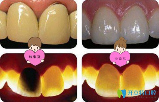 烤瓷牙与全瓷牙修复后效果展示图